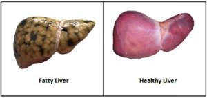 Fatty Liver Disease